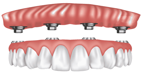 Ball-Retained Dentures Lansing, MI