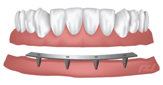 Bar-Retained Dentures Lansing, MI