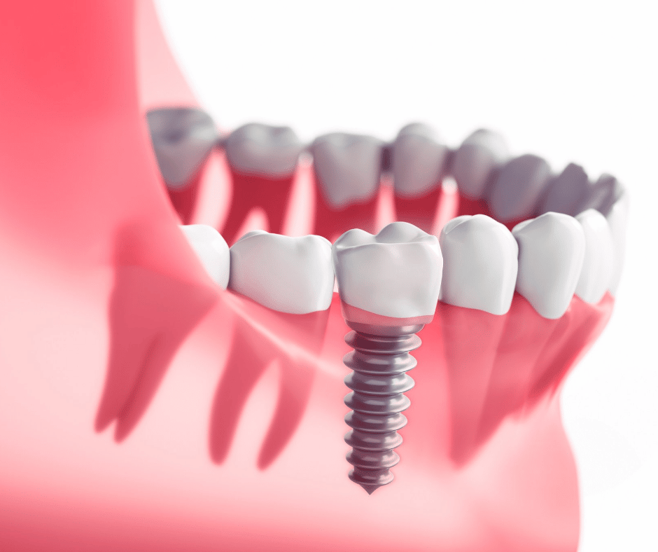Lansing Dental Implants